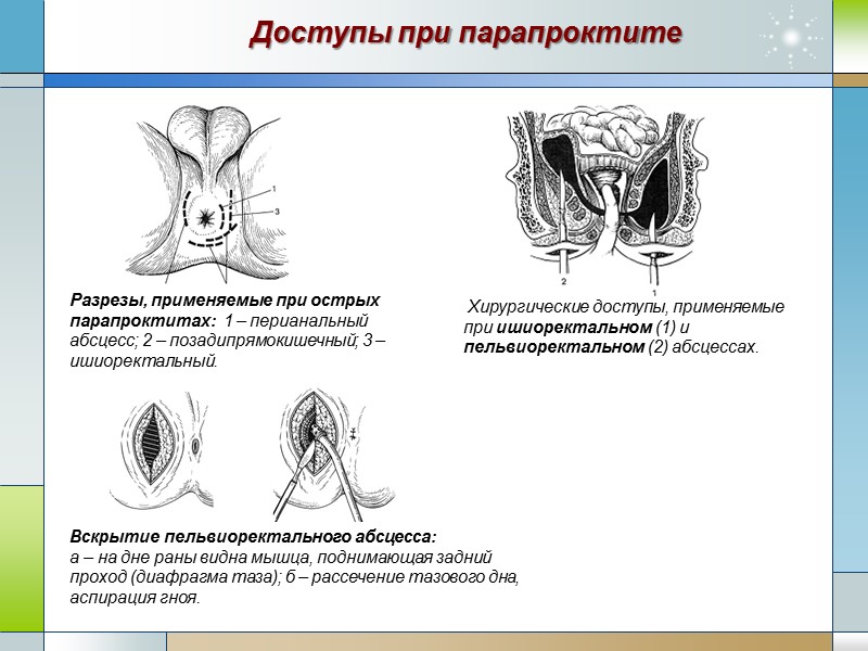 Доступы при парапроктите Разрезы, применяемые при острых парапроктитах:  1 – перианальный абсцесс; 2